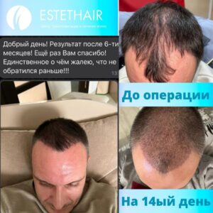 Пересадка волос методом FUE — результат через 6 месяцев